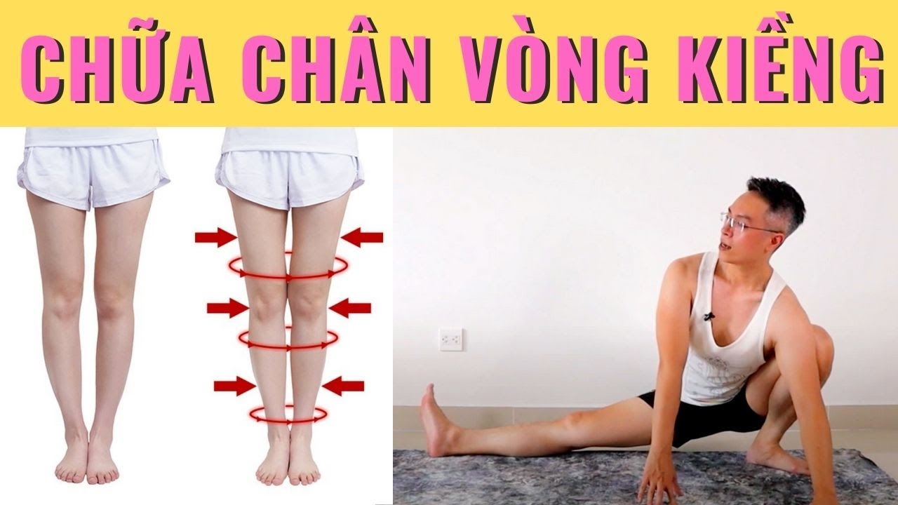 Bị chân vòng kiềng có ảnh hưởng gì không? - Tìm hiểu về tình trạng này và cách cải thiện