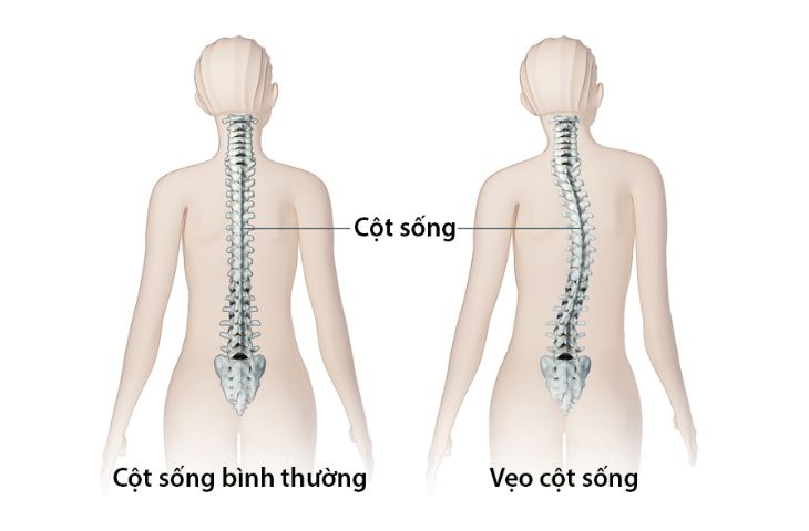 cong vẹo cột sống là gì?